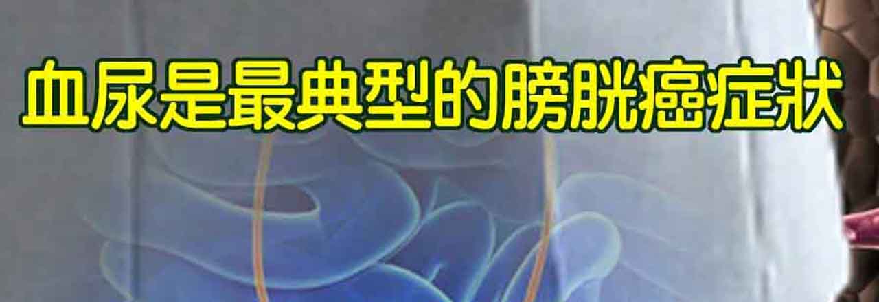 中醫膀胱癌治療