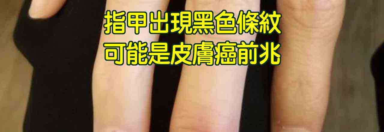 中醫皮膚癌治療