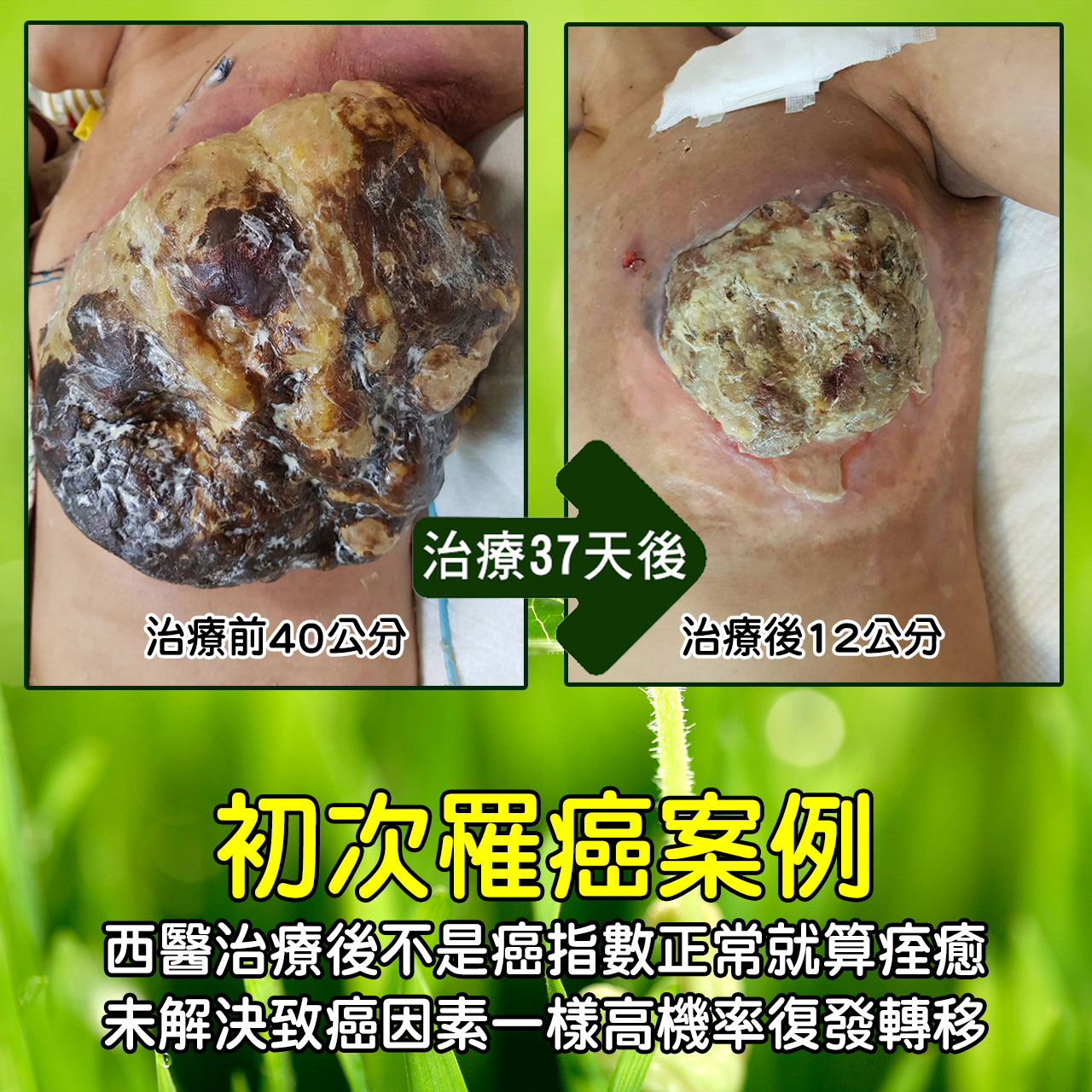 中醫大腸癌治療