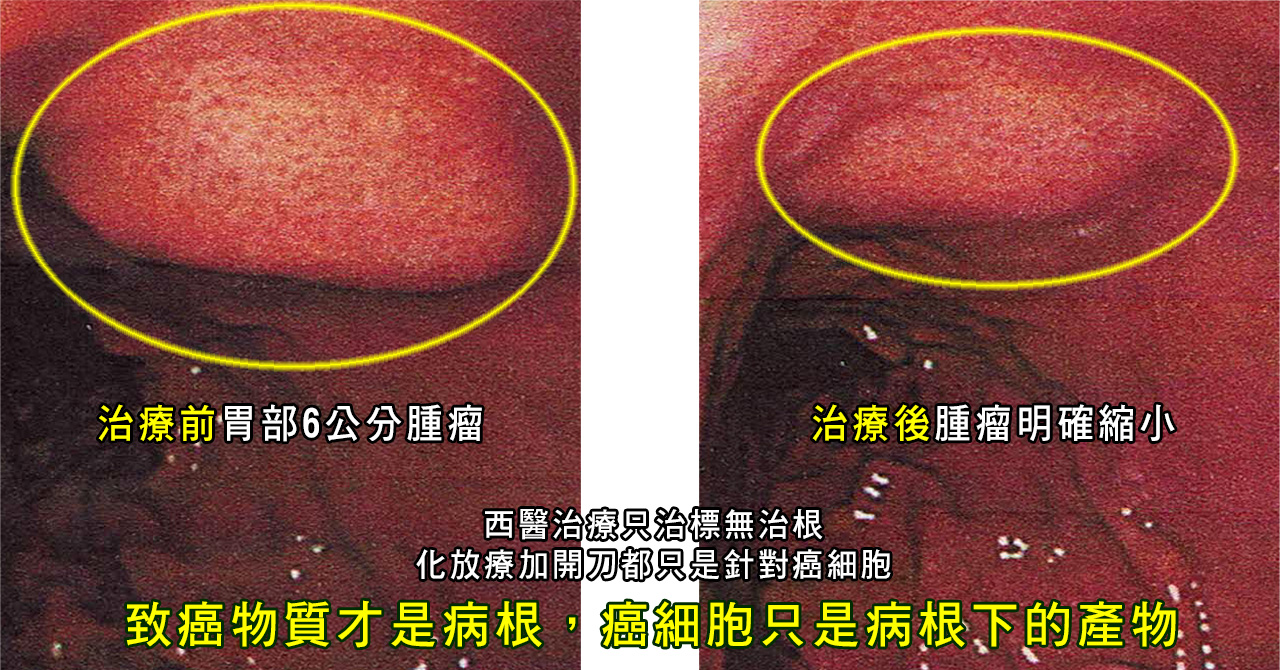 中醫胃癌復發治療_腫瘤癌症復發轉移治療案例-1